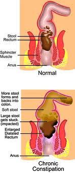 Constipation Bowel Management Fasting